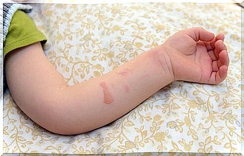 If your child gets burned by boiling water, assess the wound to see what helps to apply.